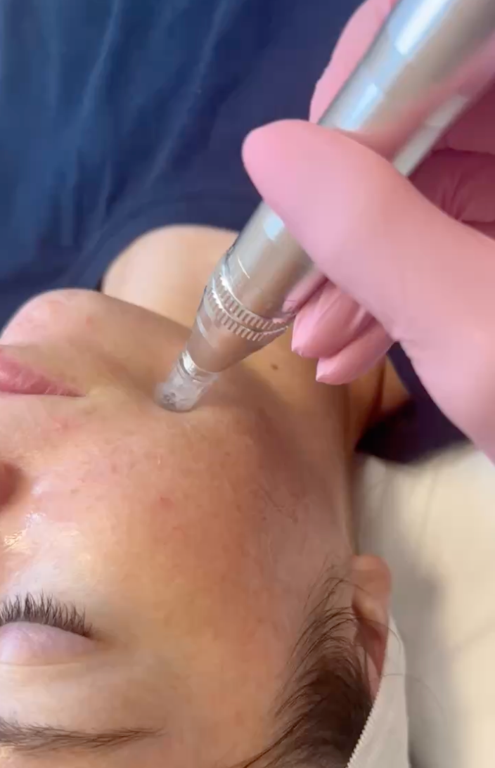 Person receiving a facial treatment with a pen-like device on a blurred background